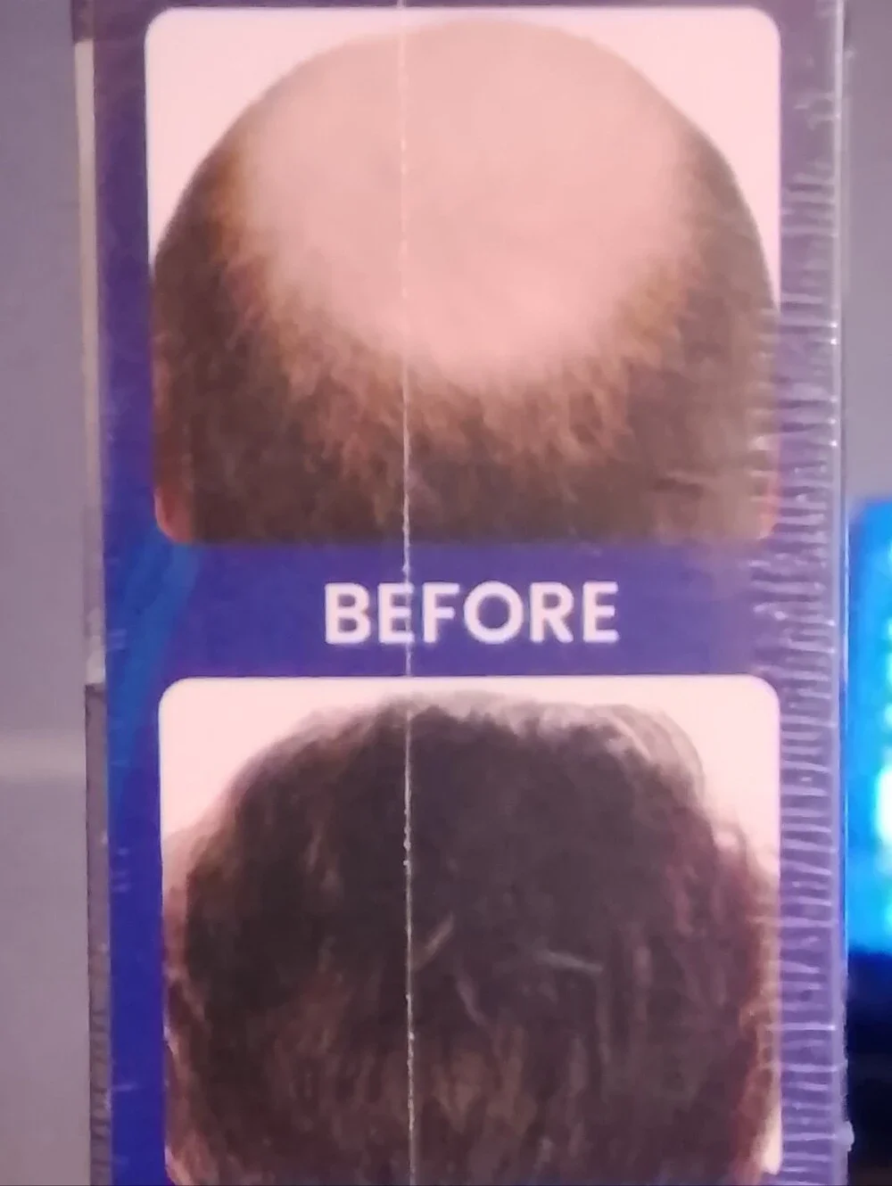 Men’s Minoxidil Foam 5% Hair Regrowth Treatment